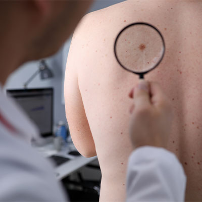 Skin Biopsies Skin Biopsies
