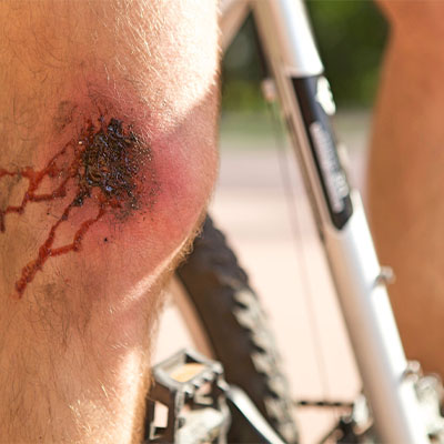 abrasion from bike accident